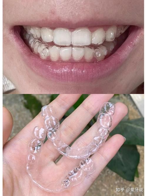 北京牙齿矫正去哪里做比较好?-图1 北京牙齿矫正去哪里做比较好?-图1