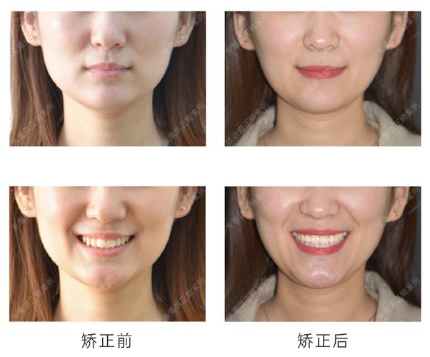 牙齿矫正前后脸型变化大不大？矫正效果如何影响脸型？-图1