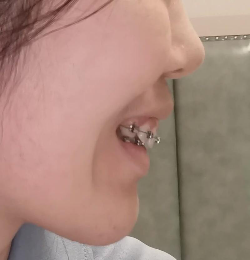 牙齿缝隙可以通过矫正闭合吗？-图2