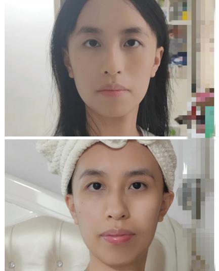 拔牙矫正牙齿后，脸型真的会发生改变吗？-图2