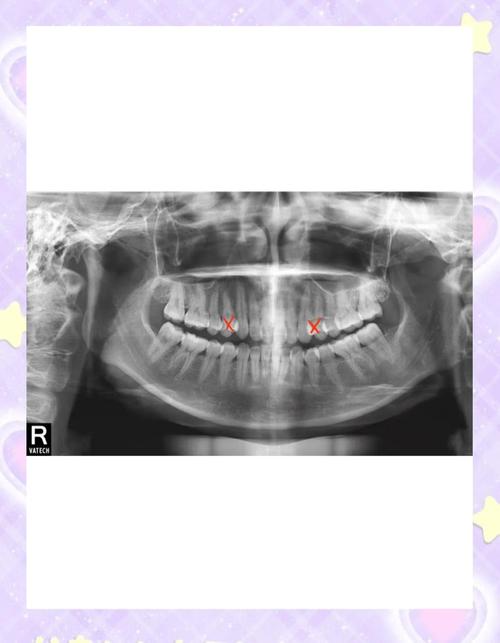 29岁矫正牙齿还来得及吗？成年人做矫正晚不晚？-图3