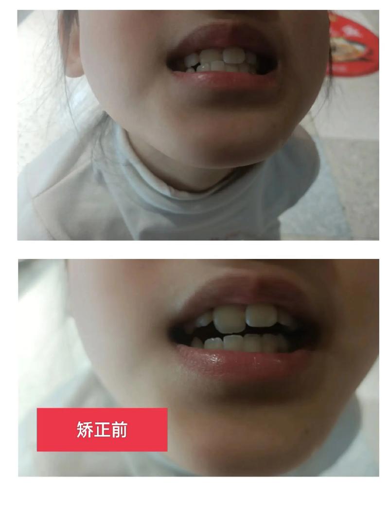 矫正牙齿到底有多痛苦?过程真的很折磨人吗?-图2 矫正牙齿到底有多痛苦?过程真的很折磨人吗?-图2