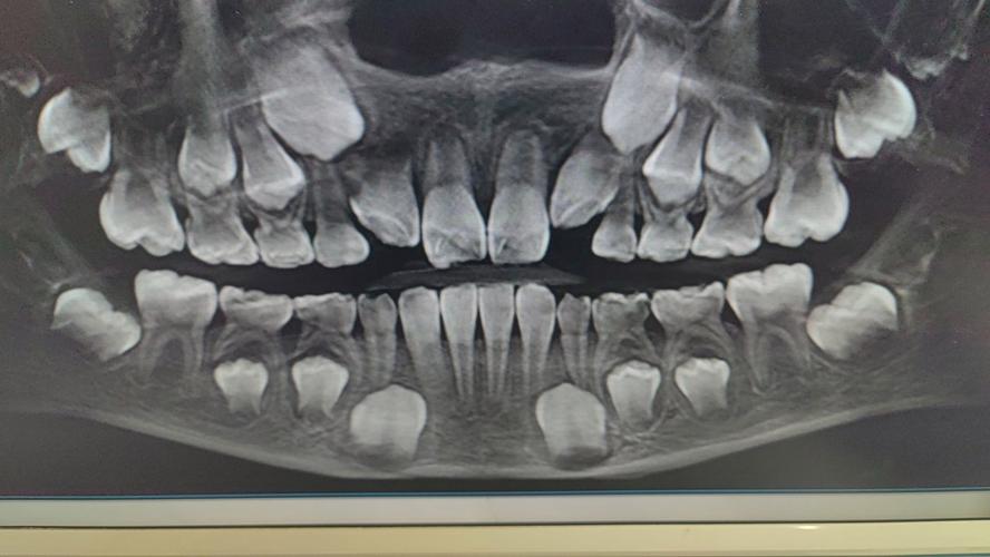 矫正牙齿要拍哪些片子？不同片子的检查重点是什么？-图2