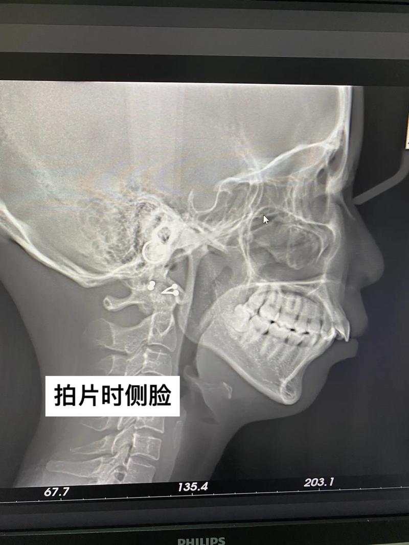 矫正牙齿要拍哪些片子？不同片子的检查重点是什么？-图3
