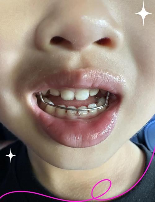 地包天矫正牙齿前照片-图1