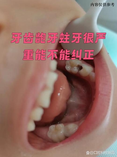 暴牙齿矫正的后果有哪些？风险大吗？-图3