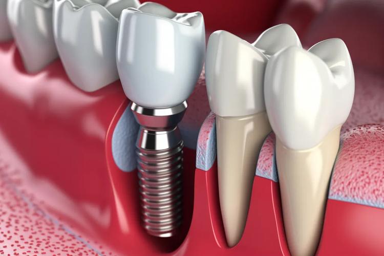 种植牙可以牙齿矫正吗-图2