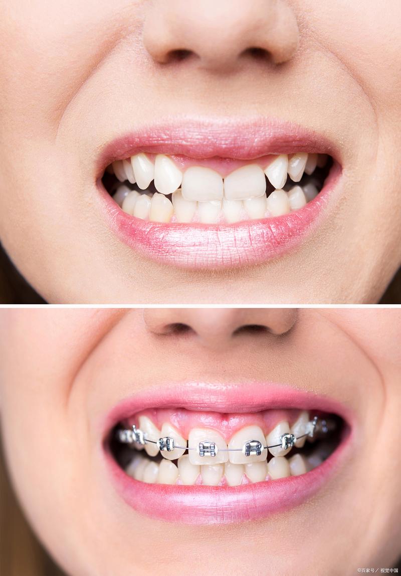 牙齿矫正有年纪限制吗？多大年纪还能矫正？-图2