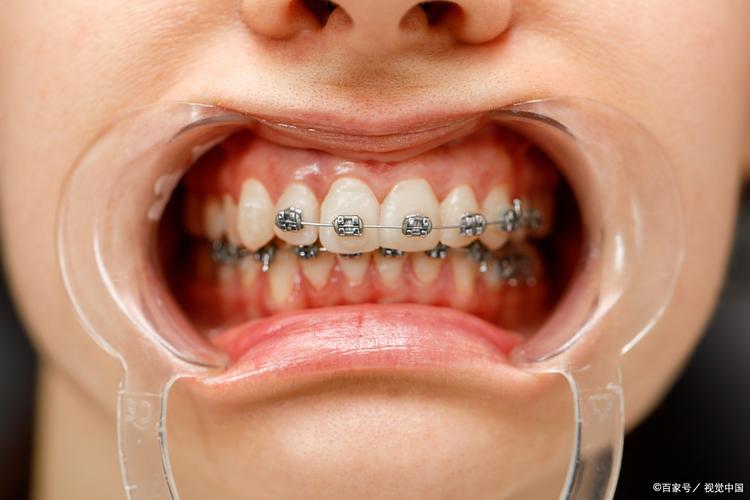 牙齿矫正后,你们真的后悔吗?-图2 牙齿矫正后,你们真的后悔吗?-图2