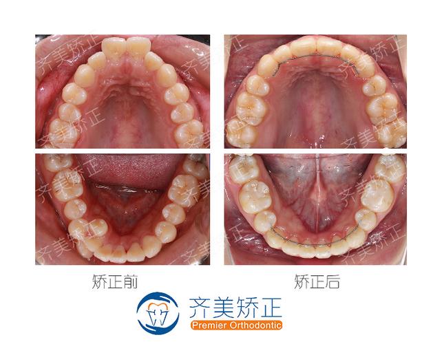 拔牙矫正牙齿前后图片-图2 拔牙矫正牙齿前后图片-图2