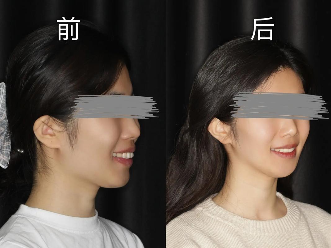 拔牙矫正牙齿前后图片-图3 拔牙矫正牙齿前后图片-图3