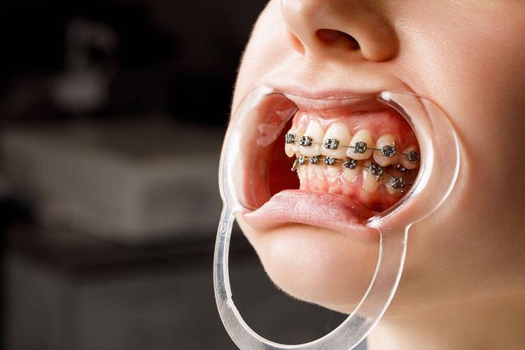 28岁矫正牙齿还来得及吗？成年矫正是否可行？-图1