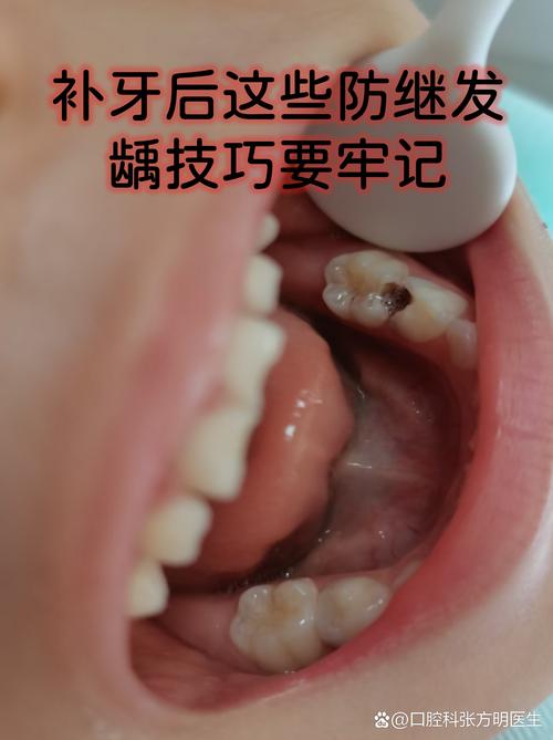 龋齿患者能做牙齿矫正吗？-图1