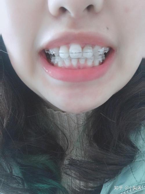 20岁做牙齿矫正还来得及吗？-图2
