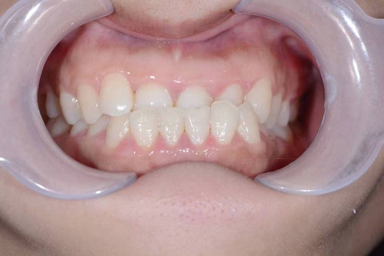 27岁地包天矫正，成年后矫正效果会受年龄影响吗？-图2