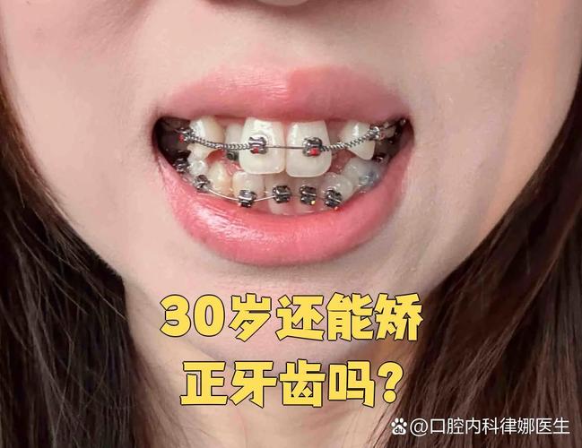 成人牙齿矫正过程图片能看出牙齿矫正的哪些关键变化？-图1