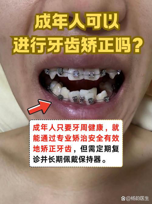 成人牙齿矫正还能做吗?-图2 成人牙齿矫正还能做吗?-图2