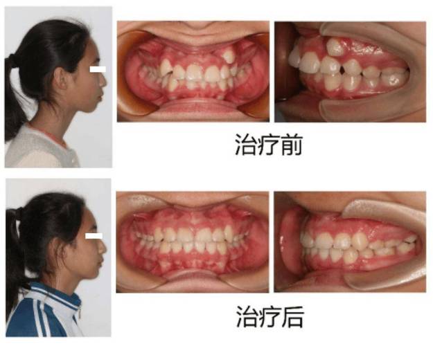 成人矫正牙齿要拔牙吗-图3