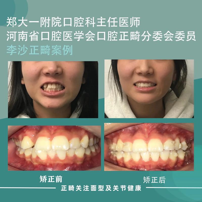 牙齿矫正必须签协议吗？-图1