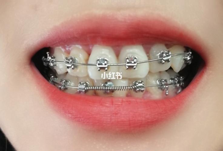 牙齿矫正必须签协议吗？-图2