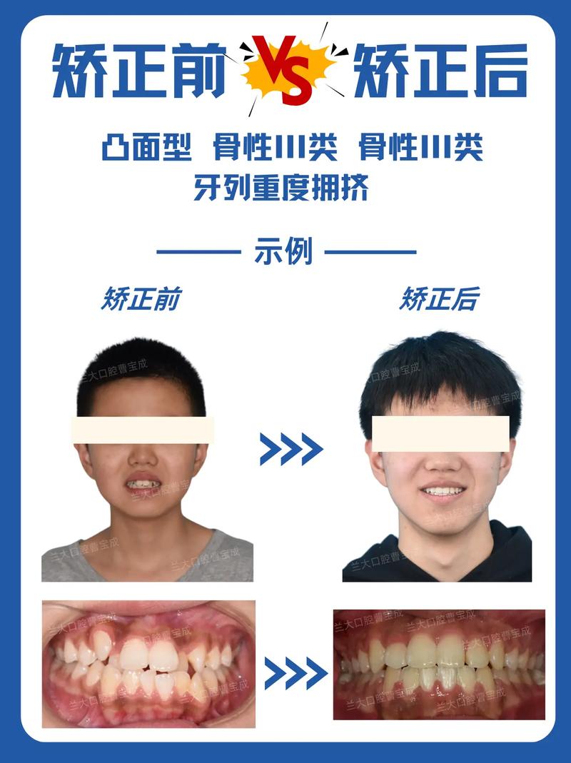 矫正牙齿会改变牙床形态吗？-图1