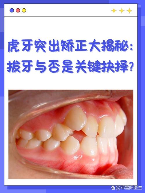 矫正牙齿能保留虎牙吗-图2