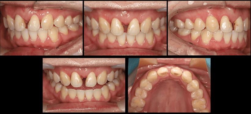 牙齿矫正以后牙缝变大-图2