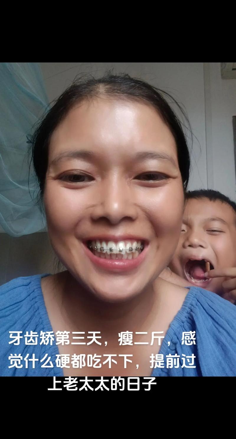 35岁矫正牙齿还适合吗？成年人矫正来得及吗？-图2