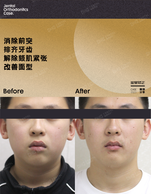 矫正牙齿对下巴形态有何影响？-图3
