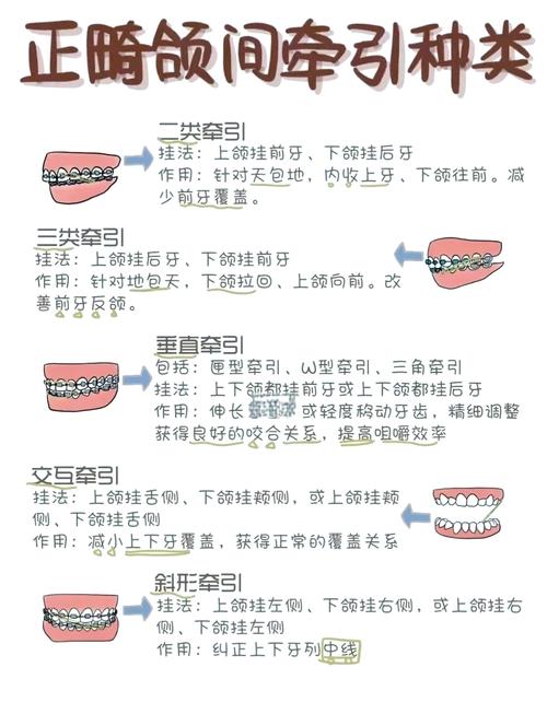 矫正牙齿原理视频教程-图3