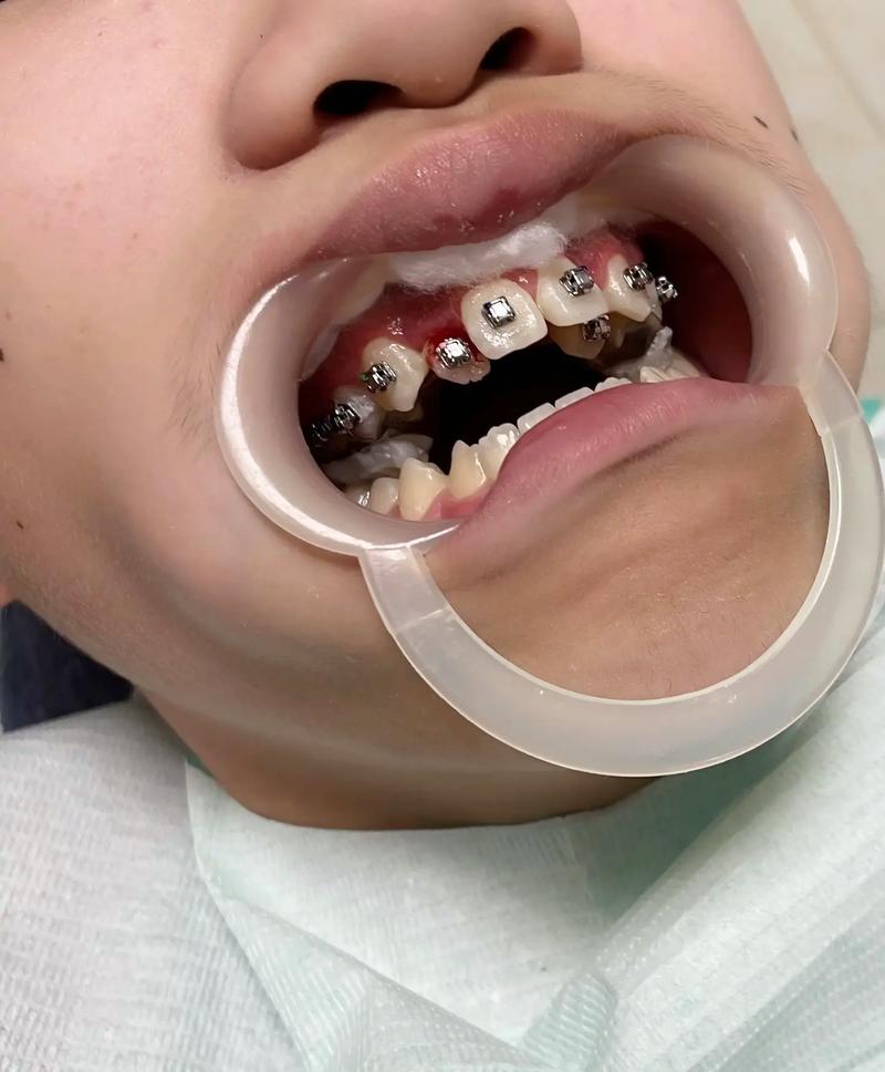 矫正后牙缝收不完，到底是什么原因？-图1