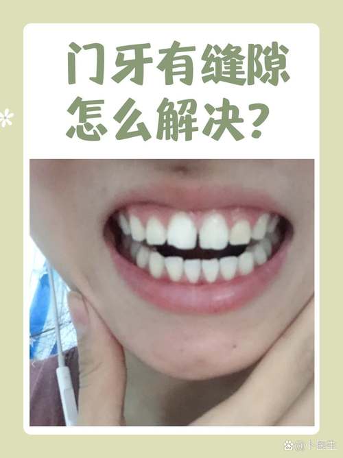矫正后门牙为何留缝隙？是矫正失败还是正常现象？-图2