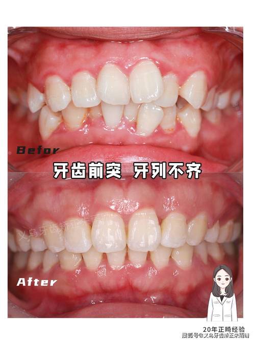 前牙凸矫正案例，为何这样矫正？效果如何？-图2