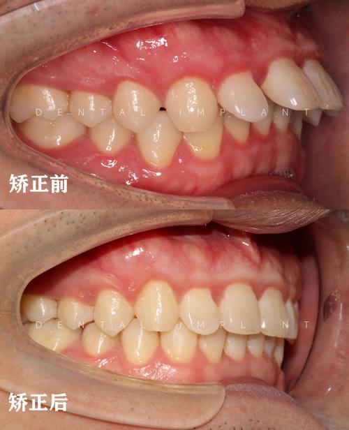 前牙凸矫正案例，为何这样矫正？效果如何？-图3