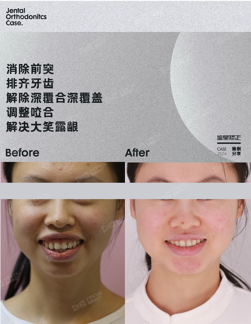 35岁矫正牙齿晚不晚?中年变美还有机会吗?-图2 35岁矫正牙齿晚不晚?中年变美还有机会吗?-图2