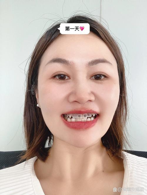 35岁矫正牙齿晚不晚?中年变美还有机会吗?-图3 35岁矫正牙齿晚不晚?中年变美还有机会吗?-图3