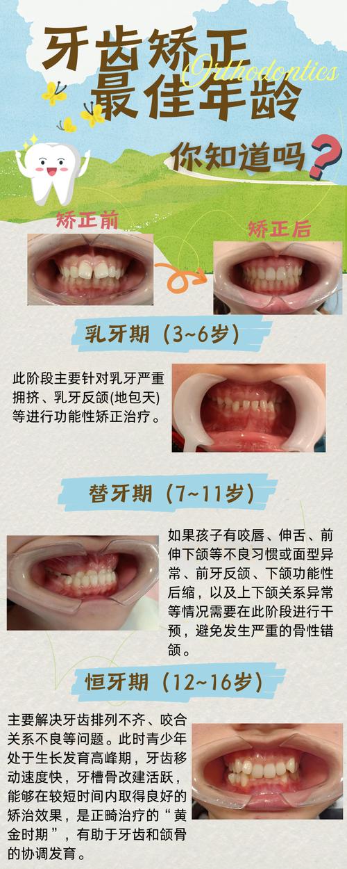 牙齿矫正什么时候合适-图2
