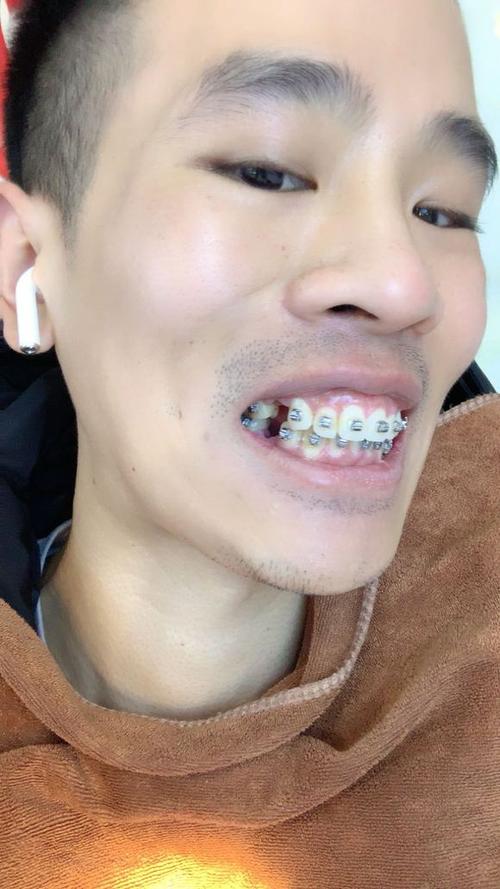 模拟龅牙矫正牙齿视频-图2