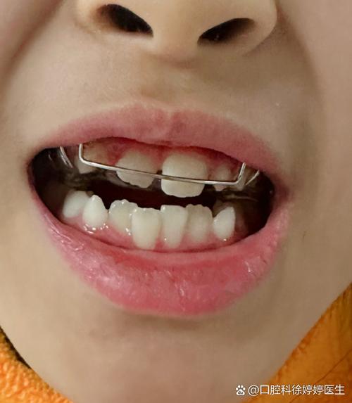 小孩矫正牙齿多大年龄开始矫正最好？-图3