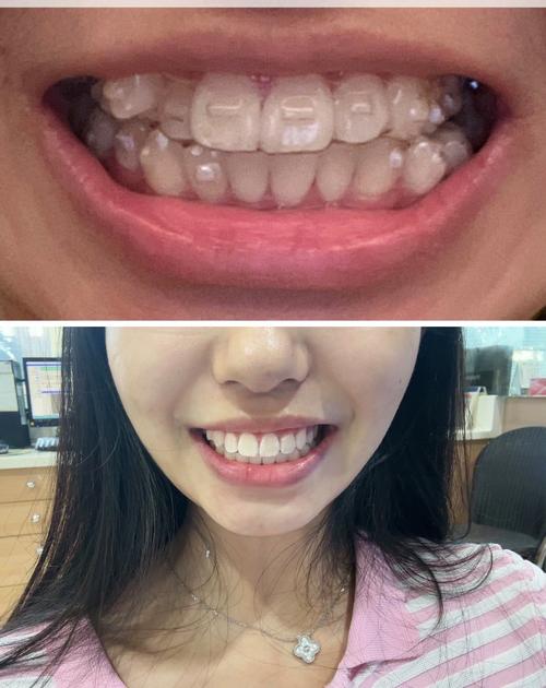 隐形矫正牙齿图片对比,效果真的能通过图片看出来吗?-图1 隐形矫正牙齿图片对比,效果真的能通过图片看出来吗?-图1