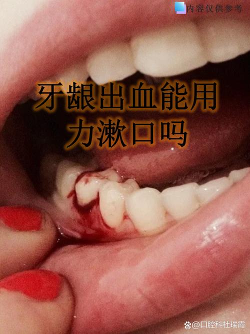 矫正牙齿期间牙龈出血，是什么原因引起的该怎么办？-图2