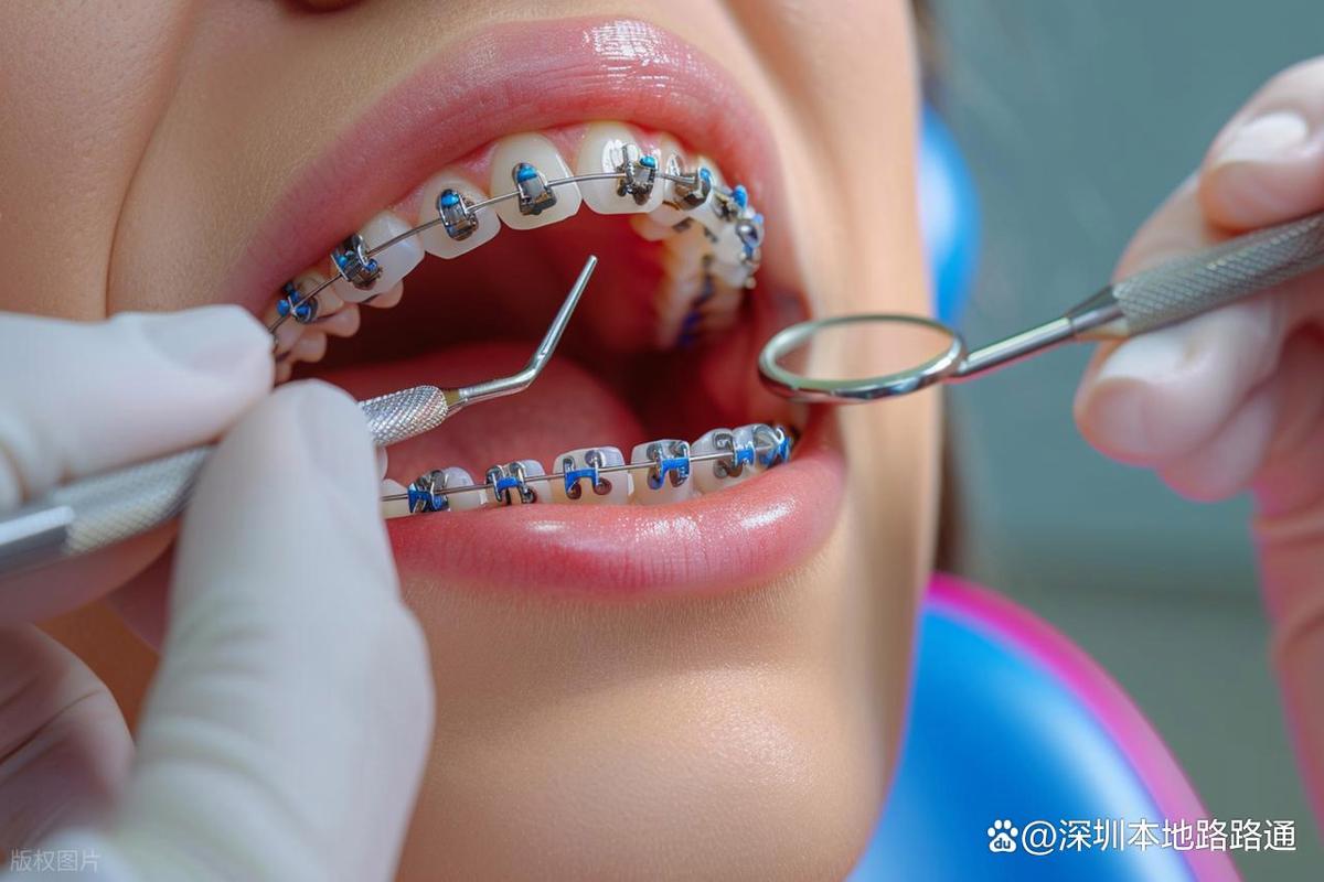 深圳牙齿矫正哪家最好?如何选到靠谱又专业的机构?-图3 深圳牙齿矫正哪家最好?如何选到靠谱又专业的机构?-图3
