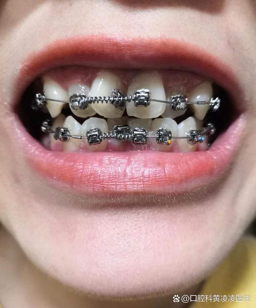 上下咬合不齐矫正有哪些有效方法？-图1