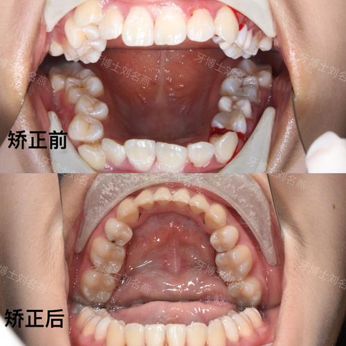 上下咬合不齐矫正有哪些有效方法？-图2