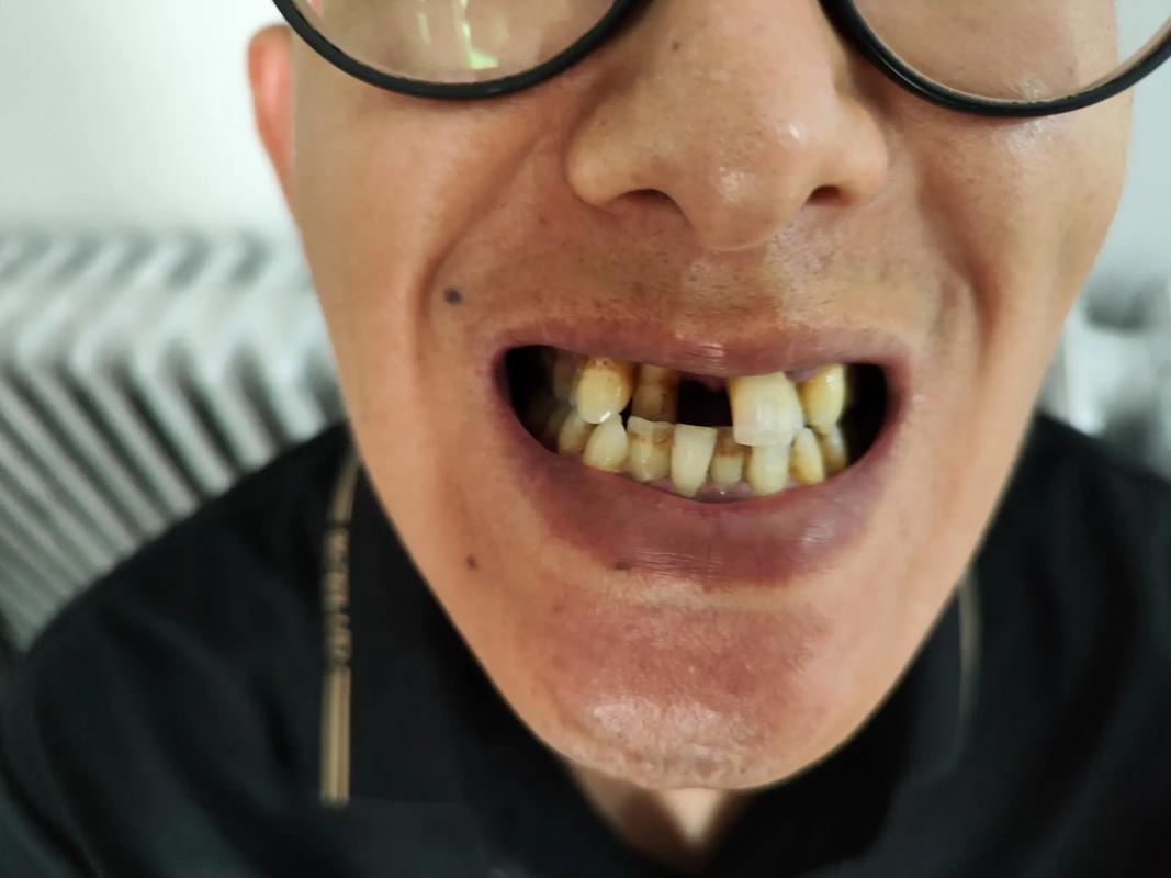 拔牙矫正老了牙齿松动，是真的吗？-图3