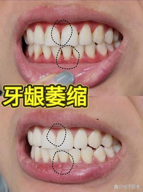 矫正牙齿导致牙龈萎缩-图2