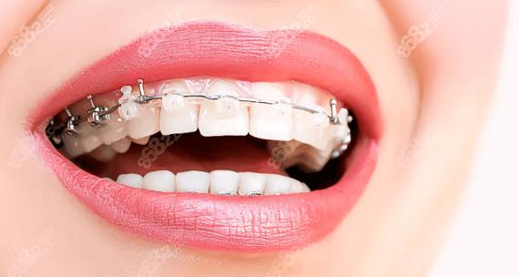 佛山矫正牙齿哪家好？热门靠谱机构推荐-图3