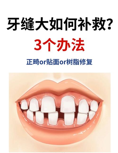 矫正牙齿关闭缝隙的过程是怎样的？具体步骤有哪些？-图3