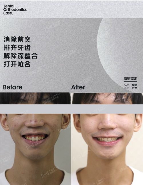 上海哪里可以矫正牙齿-图3 上海哪里可以矫正牙齿-图3