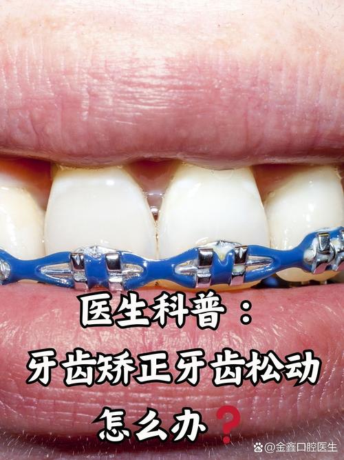矫正后牙齿松动怎么办？是否属于矫正过程中的正常现象？-图1